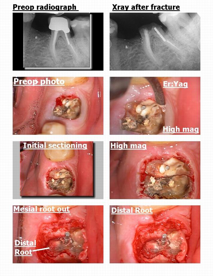 Molar extraction 1.jpg